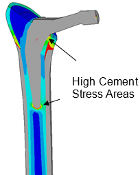 Stress Analysis of a Total Hip Replacement